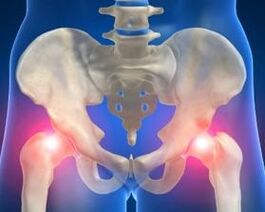 Причины остеоартроза тазобедренного сустава
